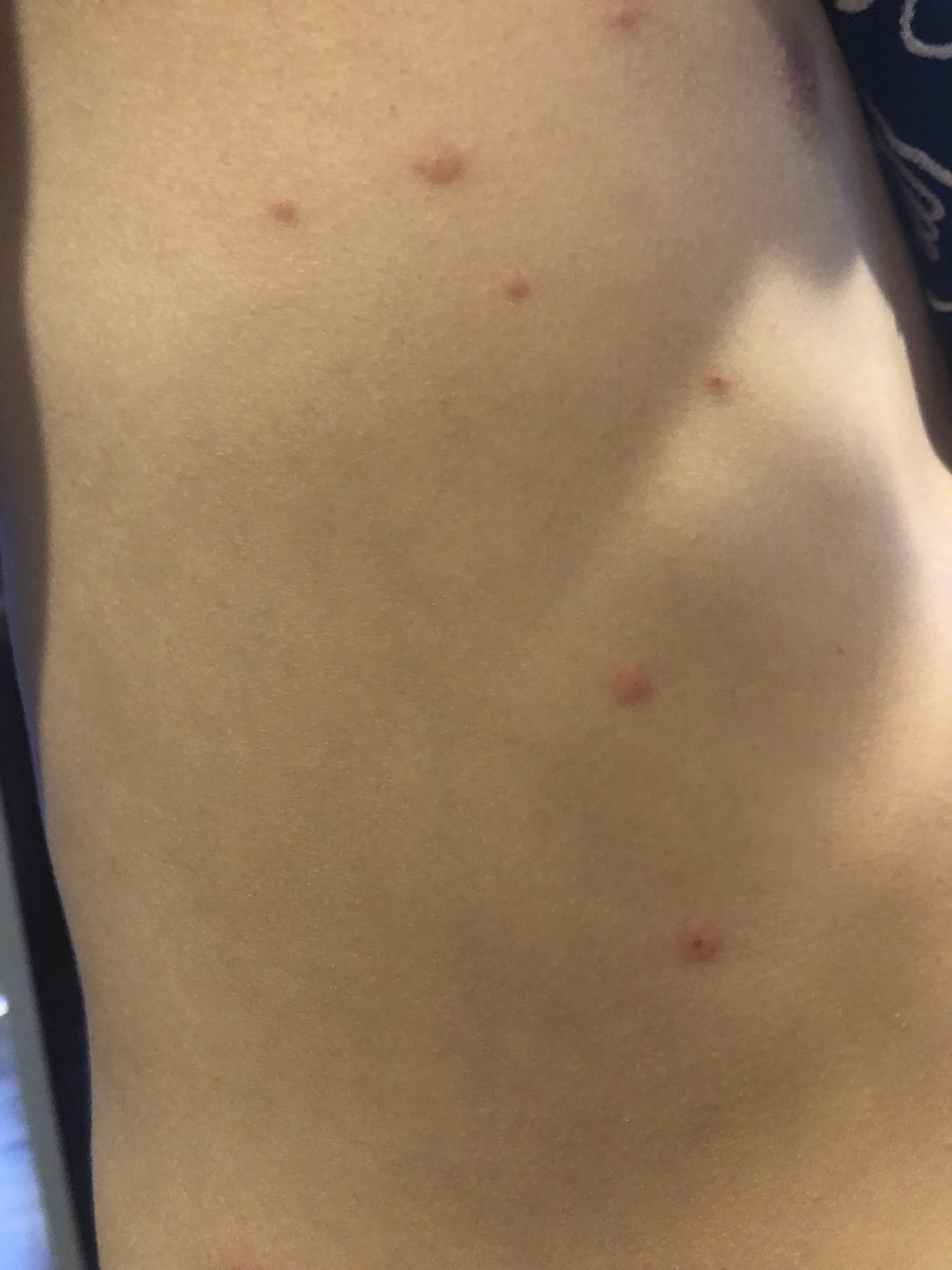 تويتر 哲戸 次郎 على تويتر うーん 予防接種済だけど水疱瘡かね ってか小生は摂取してたっけな T Co Injxox4zeg