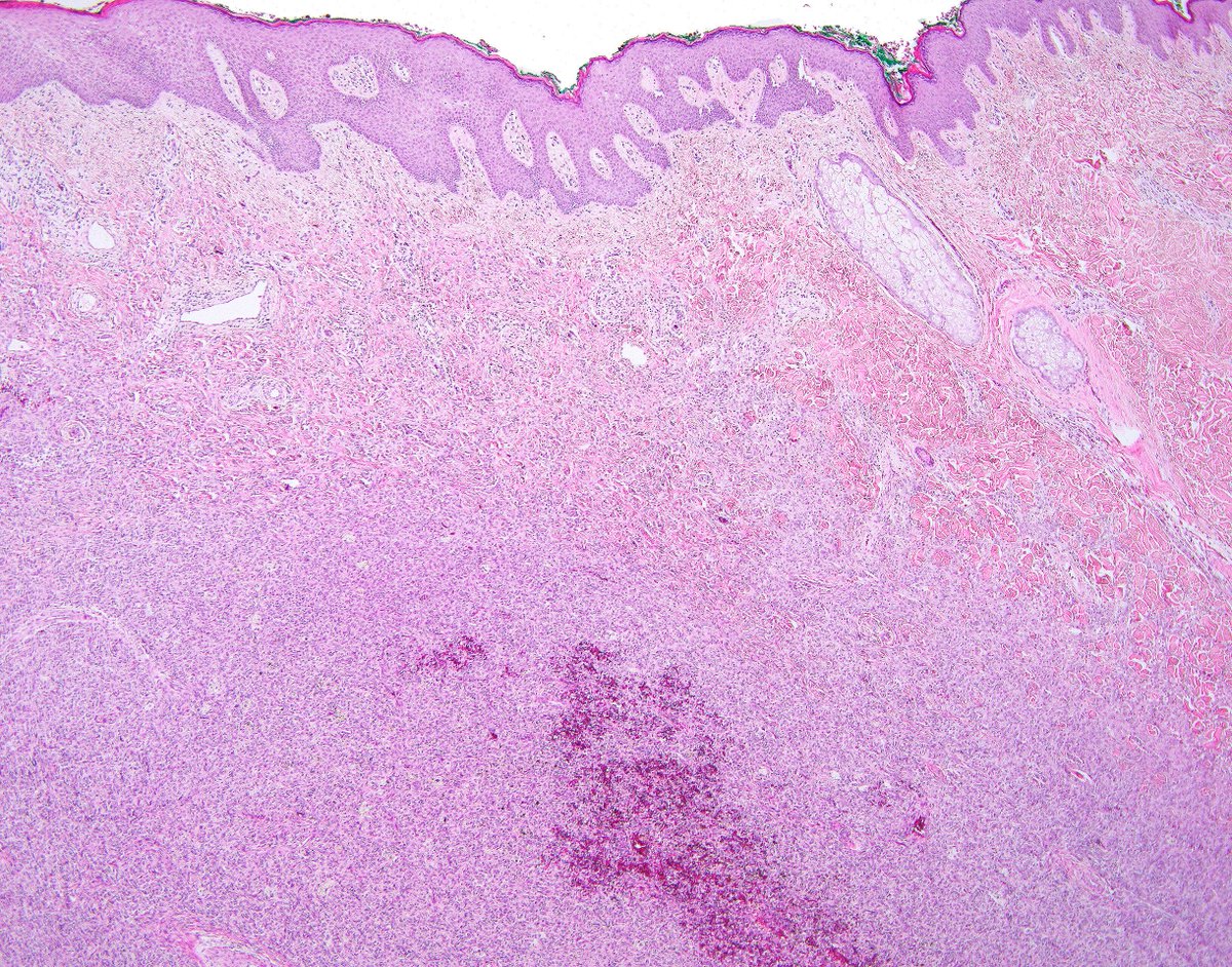 science_press's tweet photo. Aneurysmal fibrous histiocytoma (soft tissue version of dermatofibroma) can appear alarming and even have mitotic activity.  A clue is the presence of lymphocytes, plasma cells, hemosiderin and foamy macrophages. https://t.co/VWopNi6JvQ https://t.co/5wMhPCYp99