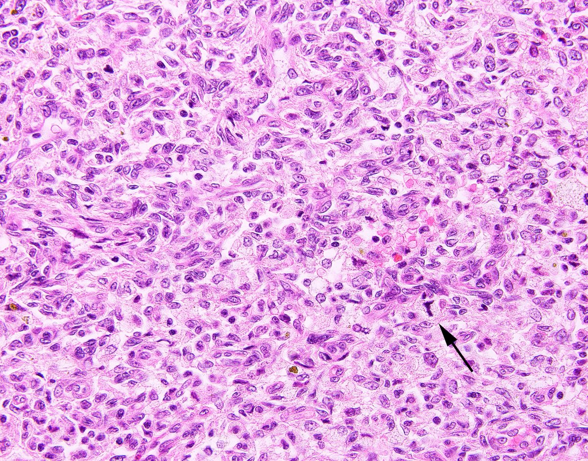science_press's tweet photo. Aneurysmal fibrous histiocytoma (soft tissue version of dermatofibroma) can appear alarming and even have mitotic activity.  A clue is the presence of lymphocytes, plasma cells, hemosiderin and foamy macrophages. https://t.co/VWopNi6JvQ https://t.co/5wMhPCYp99