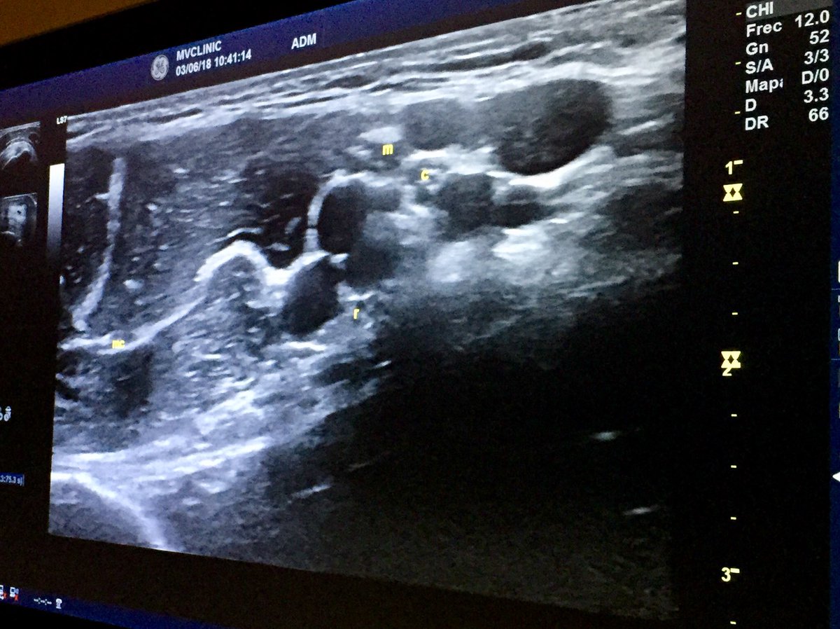 sgelite2009's tweet photo. NEUROMODULACION PERCUTANEA ECOGRAFIA ECOGUIADA sobre cadaver Thiel, de la mano de MVClinic y Ultradissection. 
Hemos trabajado abordajes nuevos invasivos y perfeccionando los que ya conocíamos en Cuello, cervical y Miembro Superior. #FisioterapiaInvasiva https://t.co/cAtxtlP8UT