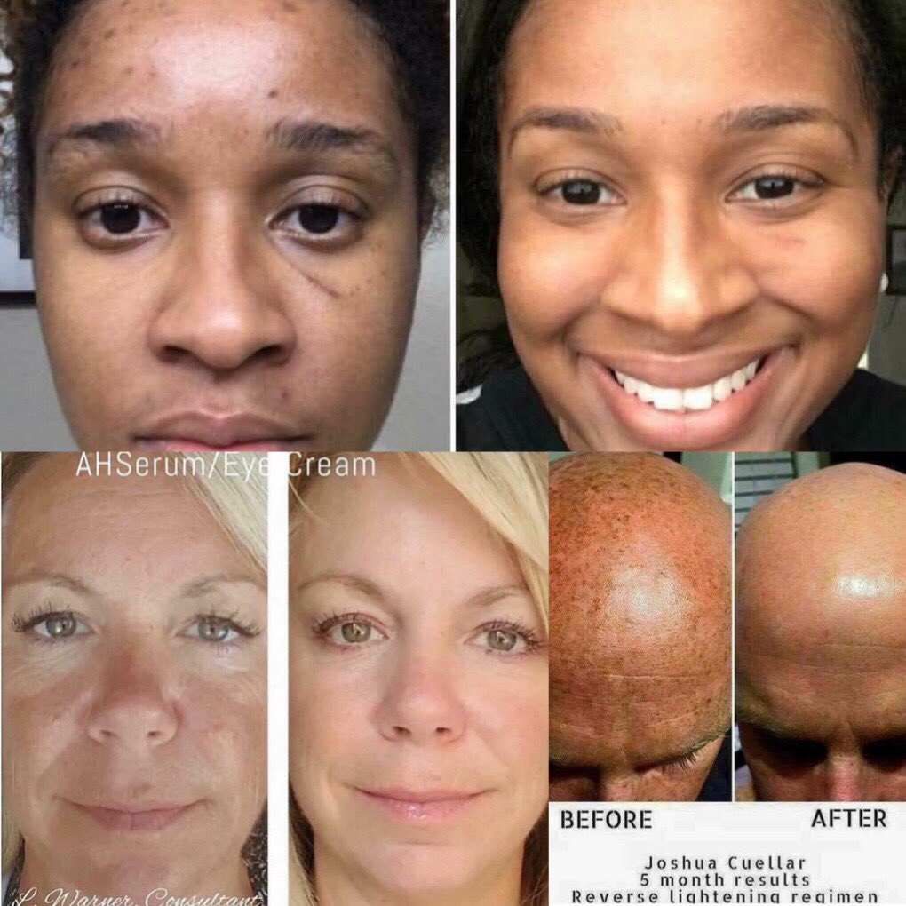 DewayneRiggins's tweet photo. Hey family - I’m now apart of Rodan and Fields Skin Care. We have products for every skin type. Get rid of blemishes, fine lines, acne and more. Look forward to a brighter, radiant, more even tone complexion.

Visit my website @ https://t.co/8zLmGSce6C https://t.co/JOLfdJ534i