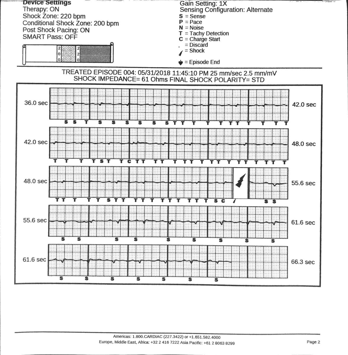 Andrew Voigt (@andrewvoigtmd) on Twitter photo 50 yo with ICM, presenting with 2 SICD shocks at rest, 8 months post implantation for primary proph. Now low R waves with P and T wave oversensing. Reprogrammed altā> primary. Have you seen this occur late p impl?. <a href="/DrJCheungEP/">Jim Cheung</a> <a href="/narrowQRS/">JMC</a> <a href="/melchami99/">Mikhael El-Chami</a> <a href="/DrJasonAndrade/">Jason Andrade</a> <a href="/Ed_Gerst/">Edward Gerstenfeld</a> 50 yo with ICM, presenting with 2 SICD shocks at rest, 8 months post implantation for primary proph. Now low R waves with P and T wave oversensing. Reprogrammed altā> primary. Have you seen this occur late p impl?. <a href="/DrJCheungEP/">Jim Cheung</a> <a href="/narrowQRS/">JMC</a> <a href="/melchami99/">Mikhael El-Chami</a> <a href="/DrJasonAndrade/">Jason Andrade</a> <a href="/Ed_Gerst/">Edward Gerstenfeld</a>