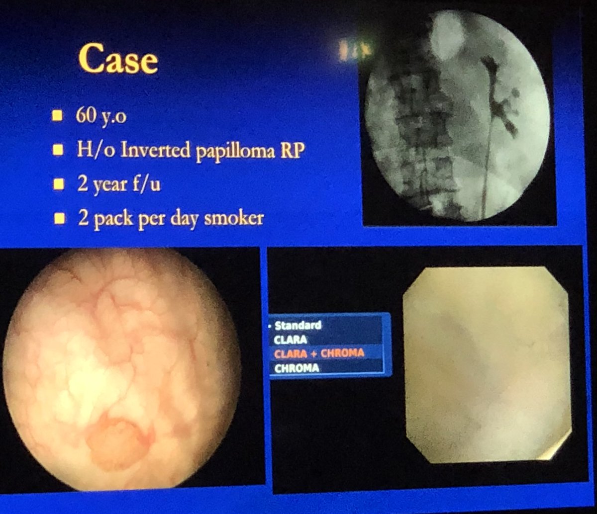 RIRS for UTUC from Michael Grasso! Brilliant presentation! #CIE18