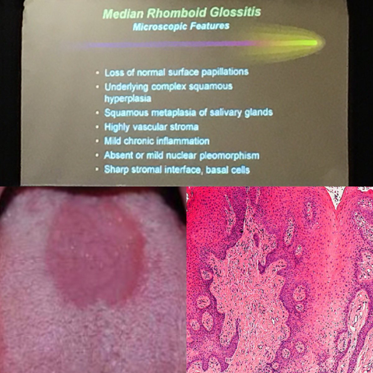 Anne Mills On Twitter Se Mills On Median Rhomboid Glossitis Scientificsympo San Diego I Had My First Case Of This Not Long Ago A Tough Lesion If You Re Unfamiliar With The Diagnosis