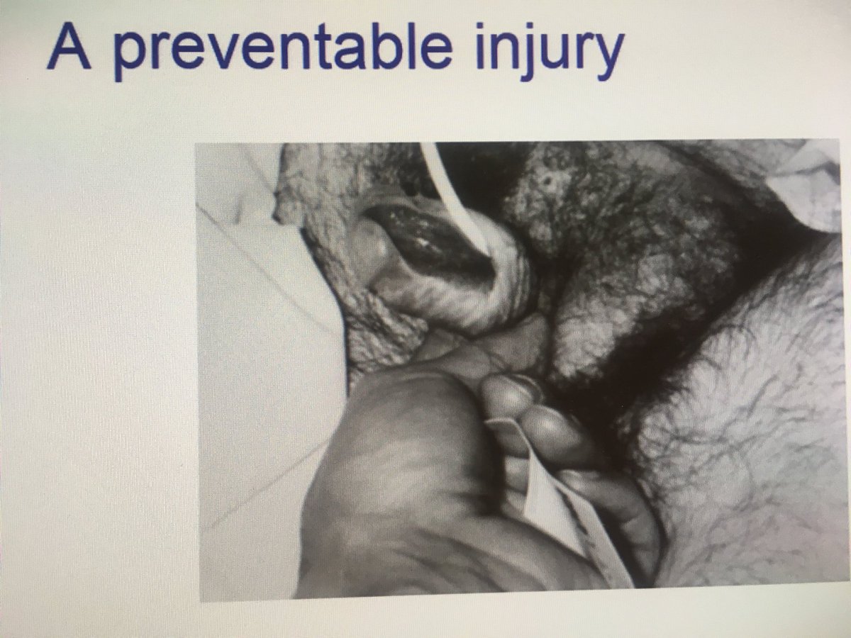 #cathetercare . This is why raising awareness about catheter care is so important . Catheters can cause serious harm . This  is caused by not securing the catheter adequately. <a href="/CoghlanVictoria/">Victoria Coghlan</a> <a href="/BronaghScott/">Bronagh Scott</a> @waters1_waters