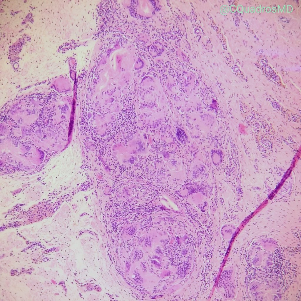CQuadrosMD's tweet photo. Just some multinucleated giant cells 😍 #pathology https://t.co/V3xbUjb1v4