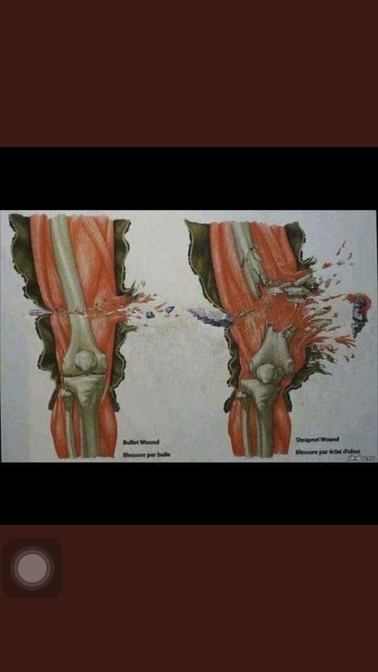 Chadi Ardelesse On Twitter Israel Utilise Des Balles Papillon Ou Dum Dum Qui Sont Bannies Par Le Droit International Et Son Utilisation Est Repertoriee Comme Un Crime De Guerre Par La Cour Penale Internationale Israel Utilise Ces Balles