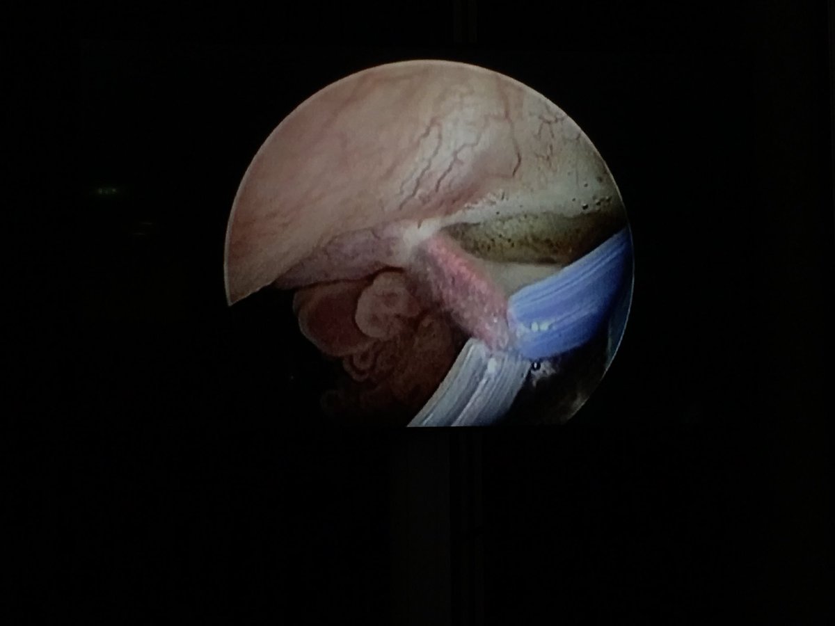 Nice En-bloc TURBT using bipolar collins knife demo for those without access to laser. Fine for smaller tumours until someone invents the intravesical retrieval bag. #cie18