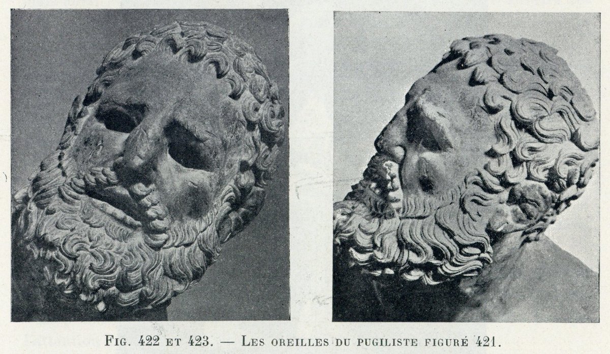 『休息するボクサー』前3世紀ごろのブロンズ彫刻。いわゆるボクサー鼻とボクサー耳が表現されている。頬や眉には傷もある。 