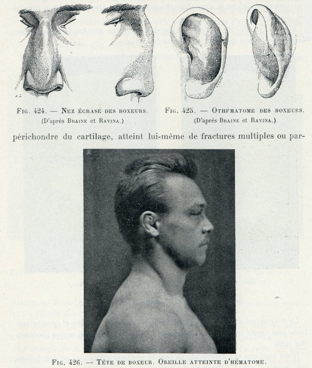 ボクサー鼻とボクサー耳の記述は、20世紀初頭の美術解剖学書にも掲載されている。美術表現としてはレアなケースだが、こうした詳細なところまで踏み込んだ研究に触れることが面白くて仕方がない。 