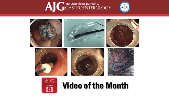 #AmJGastro Video of the Month Use of a Laparoscopic Bag for the Endoscopic Retrieval of a Large Gastric Tumor After Endoscopic Submucosal Dissection Nagami, et al. ➡️ rdcu.be/WGs3