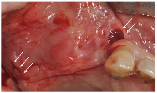 MDPIOpenAccess's tweet image. Lateral Sinus Floor Elevation Performed with Trapezoidal and Modified Triangular Flap Designs: A Randomized Pilot Study of Post-Operative Pain Using Thermal Infrared Imaging sci.fo/502 #SinusAugmentation #ThermalInfraredImaging @IJERPH_MDPI