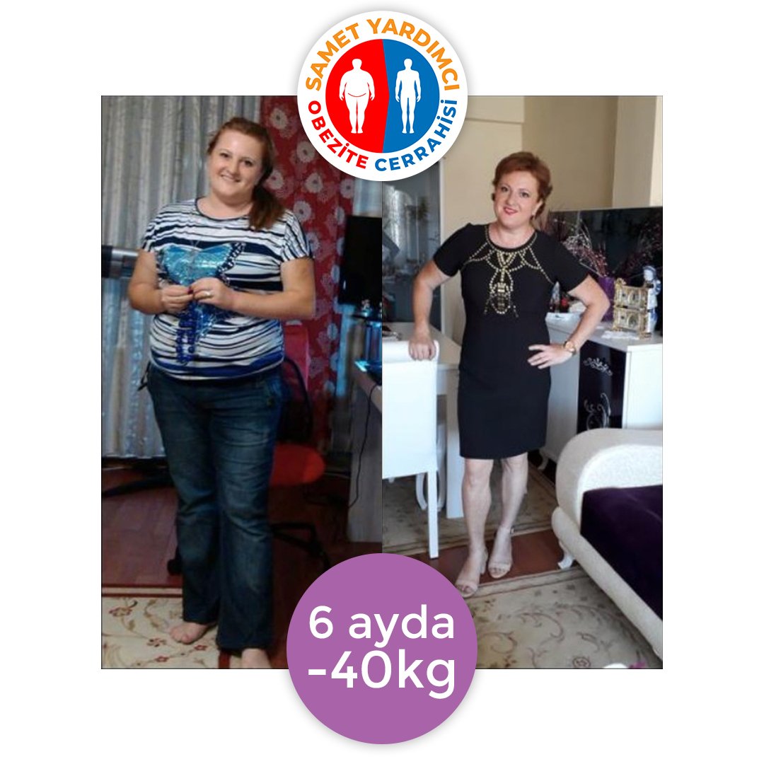 Serap Hanım da 6 ay içinde 40 kg vererek daha sağlıklı, daha hareketli ve daha mutlu bir hayata merhaba dedi. #obesity #obesitysurgery #mideküçültme #tüpmide #gastrikbypass #diyabet #metabolikcerrahi #fit #beslenme #şekerhastalığı #tip2diyabet #obezitecerrahisi #tüpmideameliyatı