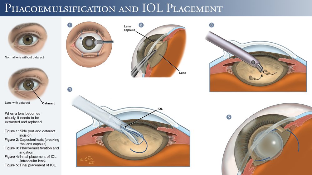 Что после катаракты нельзя делать. Факоэмульсификация катаракты с имплантацией интраокулярной линзы. Операция ультразвуковая факоэмульсификация катаракты. Катаракта операция с имплантацией ИОЛ. Факоэмульсификация катаракты этапы операции.