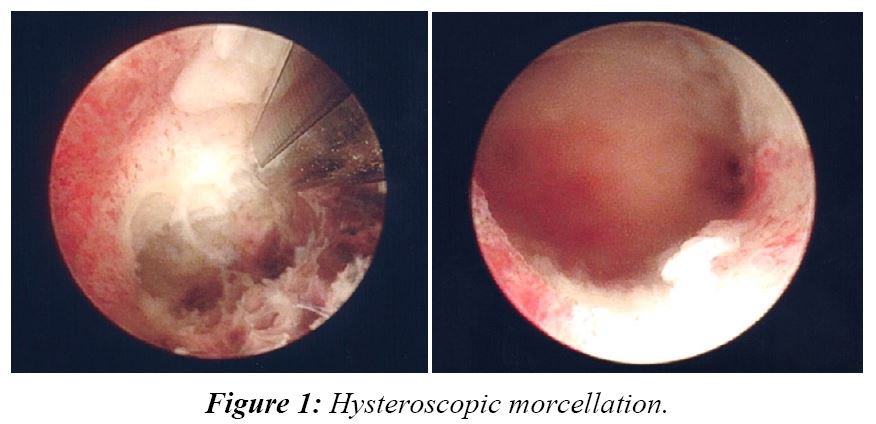 journal_rrgo's tweet photo. Hysteroscopic morcellation was found to be a safe &amp; effective means of treating persistent RPOC with complete resection &amp; symptom resolution in all cases &amp; no intraoperative or postoperative complications. #RPOC
Read: https://t.co/cgGh6KnutS 
Visit us: https://t.co/X7y0XqiL7l https://t.co/BDkpyHsWHD