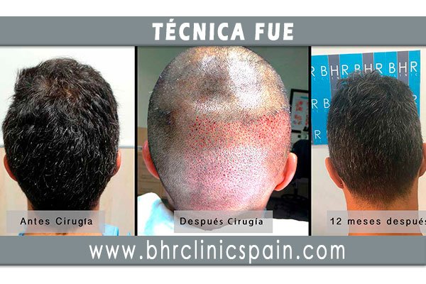 MeyeryAlcaide's tweet photo. 6 meses tras la #Intervencion, mediante la #TecnicaFUE, el paciente no ha sufrido ningún daño en la zona donante. El nacimiento del #Pelo permanece inalterable y sin apreciación de su paso por quirófano. #ResultadosNaturales📞625290933
#InjertoPelo #TrasplanteCapilar #FUE #Malaga https://t.co/fDLy3exzvB