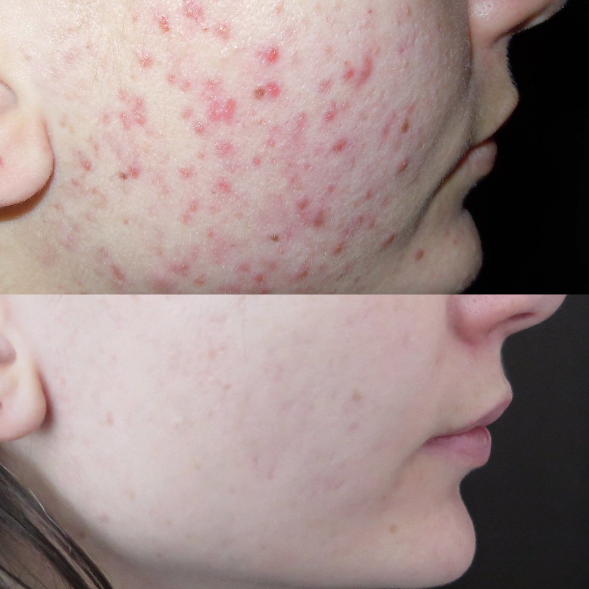 EllipseSpain's tweet photo. Probablemente en algún momento de nuestra vida hemos tenido #acne 🤔Gracias al Dr. @FrancoScardigli y a Ellipse Italia por compartir 🤗
Los parámetros en nuestro #Instagram @ellipse_spain
#ellipseresults #ellipse #SWT #SelectiveWavebandTechnology
#piel #skin #dermatologia https://t.co/zn5DVjjJFh