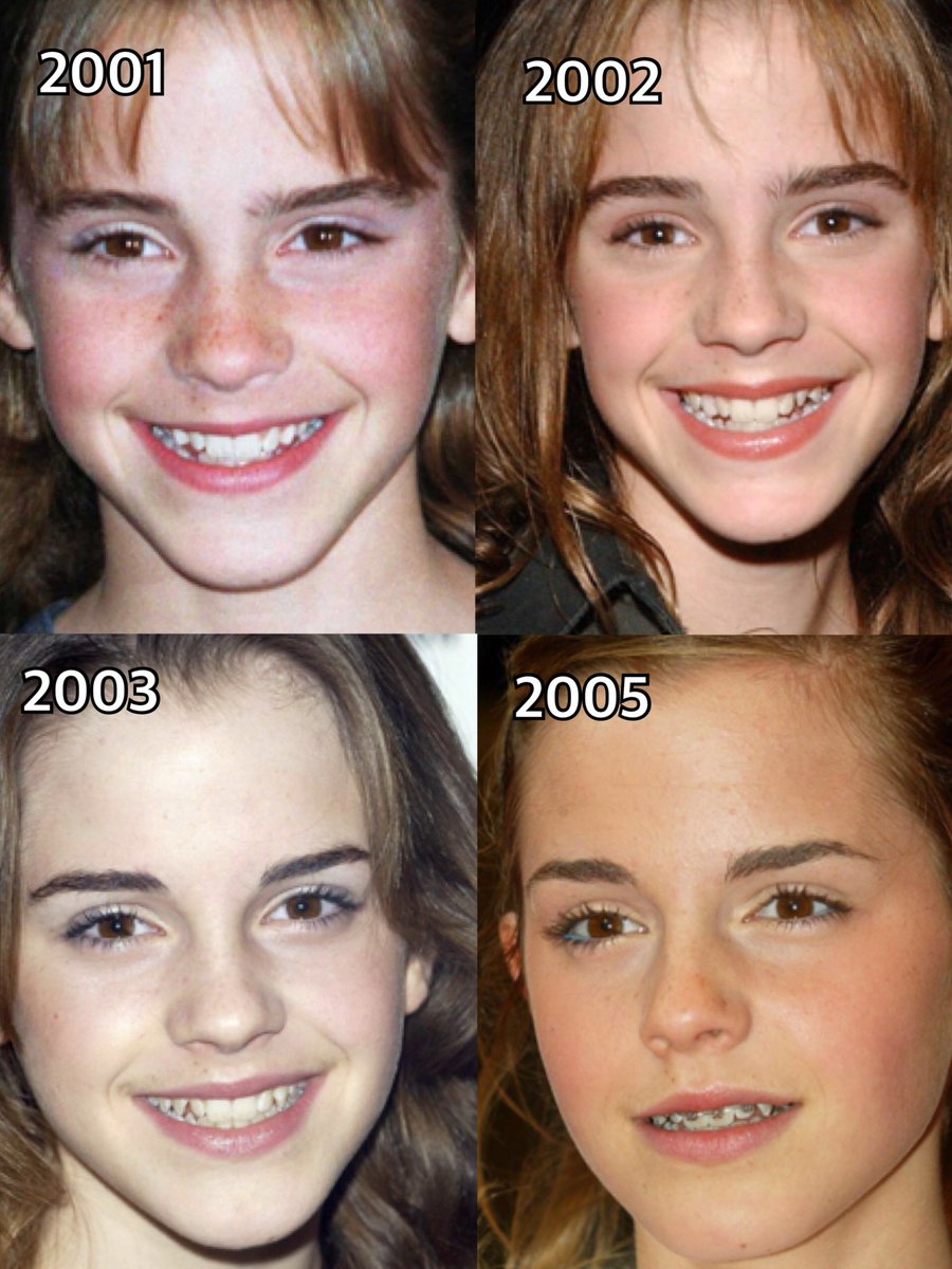 Emma Watson Japan 歯並び エマ ワトソンの歯並びの変化をまとめました 15歳で矯正器具をつけて矯正をしましたが 数ヶ月で終了しています
