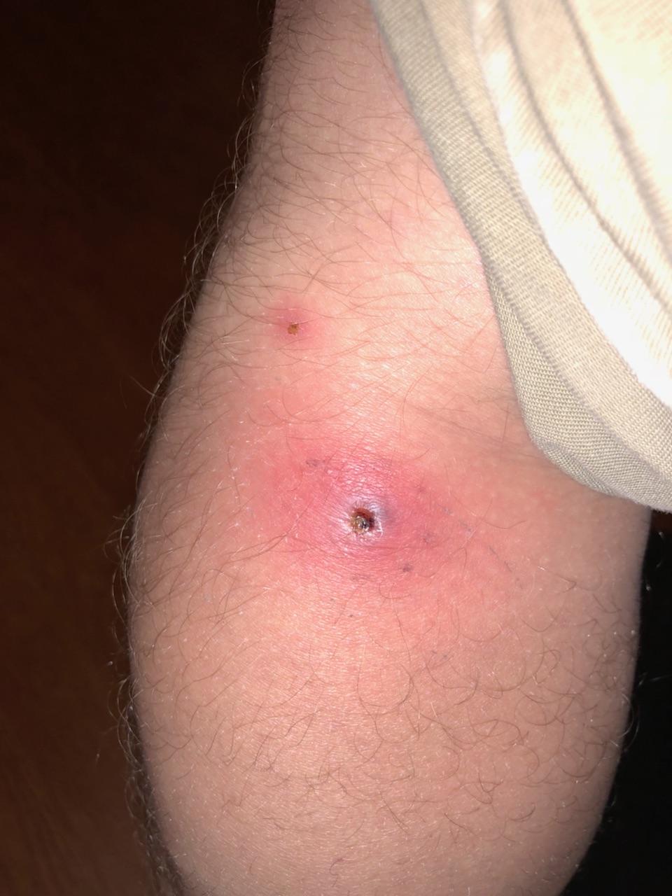 Cary Sports Medicine on Twitter: "What's that, just a scratch you say? A spider  bite you say? How about the progression on MRSA. @injurypics @MsBennettCHS  @hpagel48 @ayelmini @JBaz68 https://t.co/WLp7hi4ZLa" / Twitter