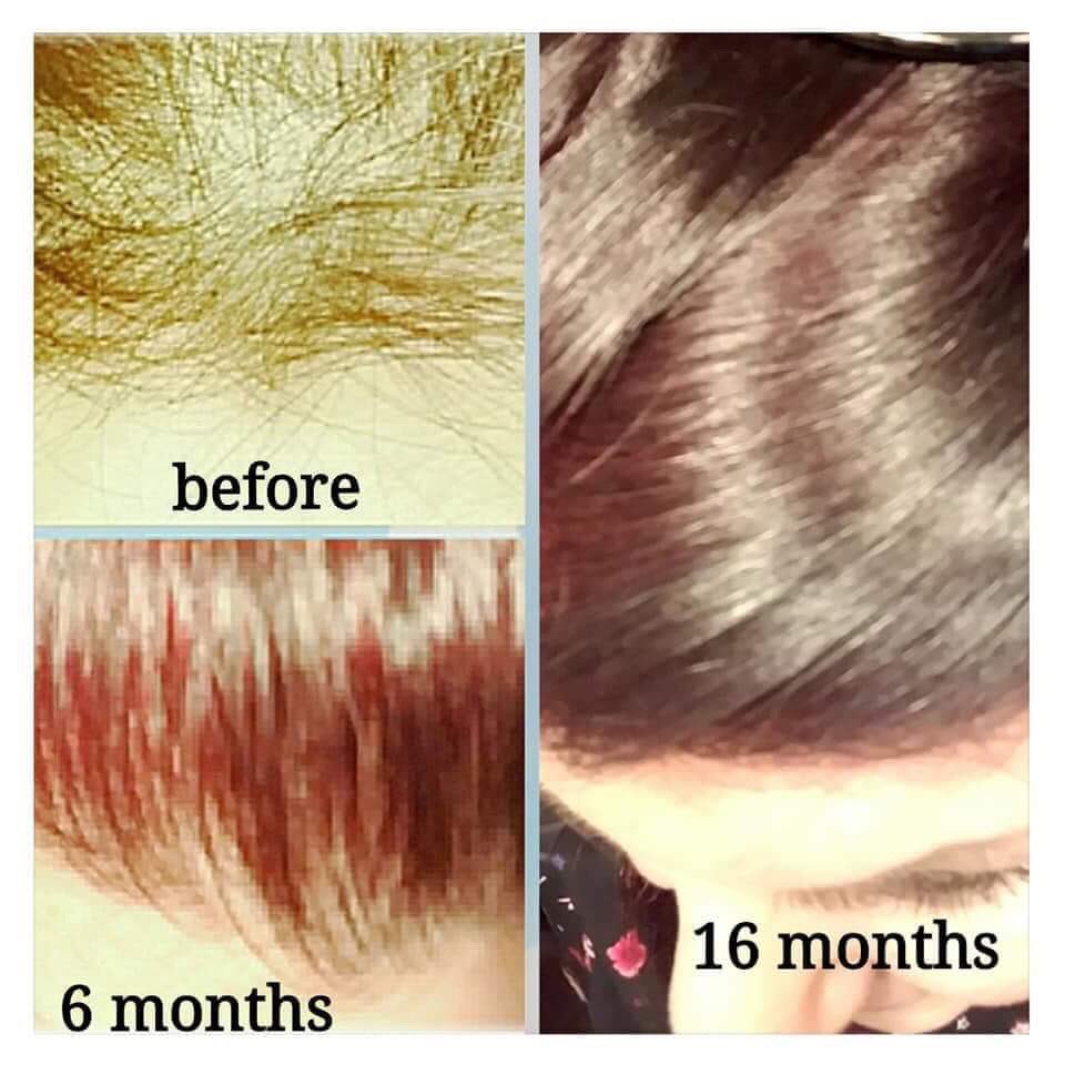 DamTheButterfly's tweet photo. Here are a few before and after pictures of Betty, a Fellow #ThyroidDisease Warrior. Read her incredible success story with a new Program we're using for us Autoimmune Disease sufferers! 💪🏻🦋

Link to Betty's story - https://t.co/CFfwCV9aDN

 #thereishope #autoimmunedisease https://t.co/LS6Gt8Dntq