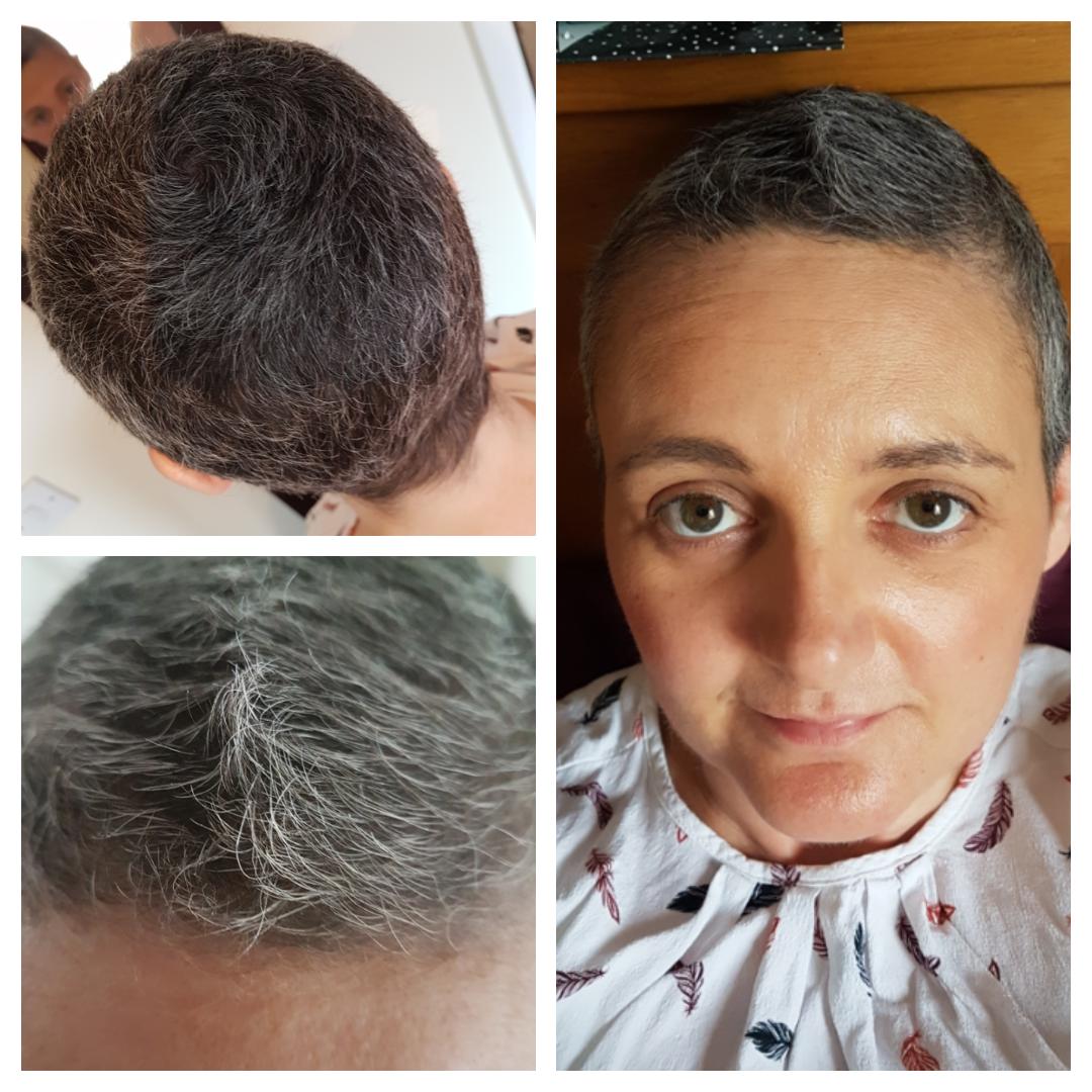 runawaygirl248's tweet photo. Todays hair growth and natural colour 😆 Its getting dyed later this week with a new chemical free water based colour thats suitable for people who have recently had #chemo hopefully goodbye grey hairs!! #hairgrowth #hairgrowing #breastcancer #cancer #greyhair #growingback https://t.co/pcMOogldr2