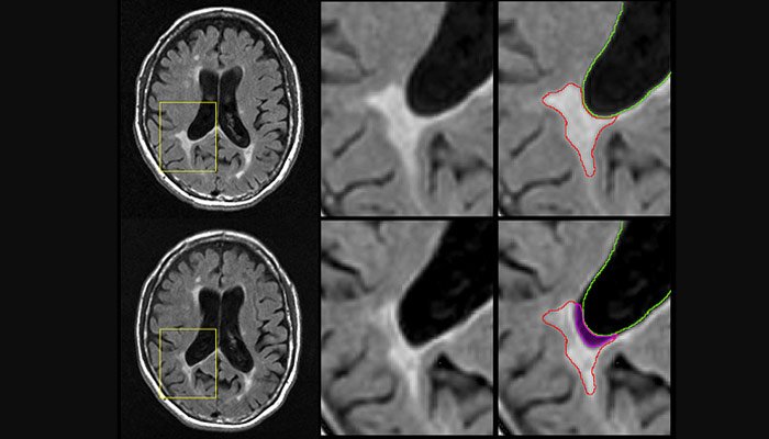 neurotiti's tweet photo. La neuroimagen de la #EsclerosisMúltiple se complica: las lesiones que ya no se reflejan en la RM pueden ser un fuerte indicador de #neurodegeneración https://t.co/ebgN0Vpgg6 https://t.co/esJzykvFjB