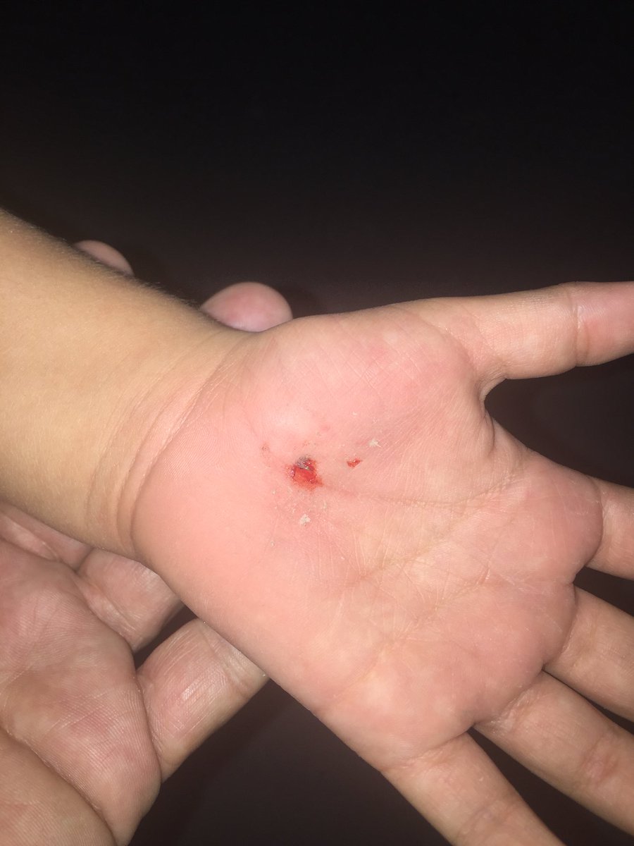 rolando2020's tweet photo. Es parte del crecer.
Manos, codos y rodillas raspadas.
jajajaja.
-Ñañañaña
-Sangre...
-Donde?
-No, solo es un raspón
-Ñañaña.
Puro drama.
🤭 https://t.co/FnAgPwRrim