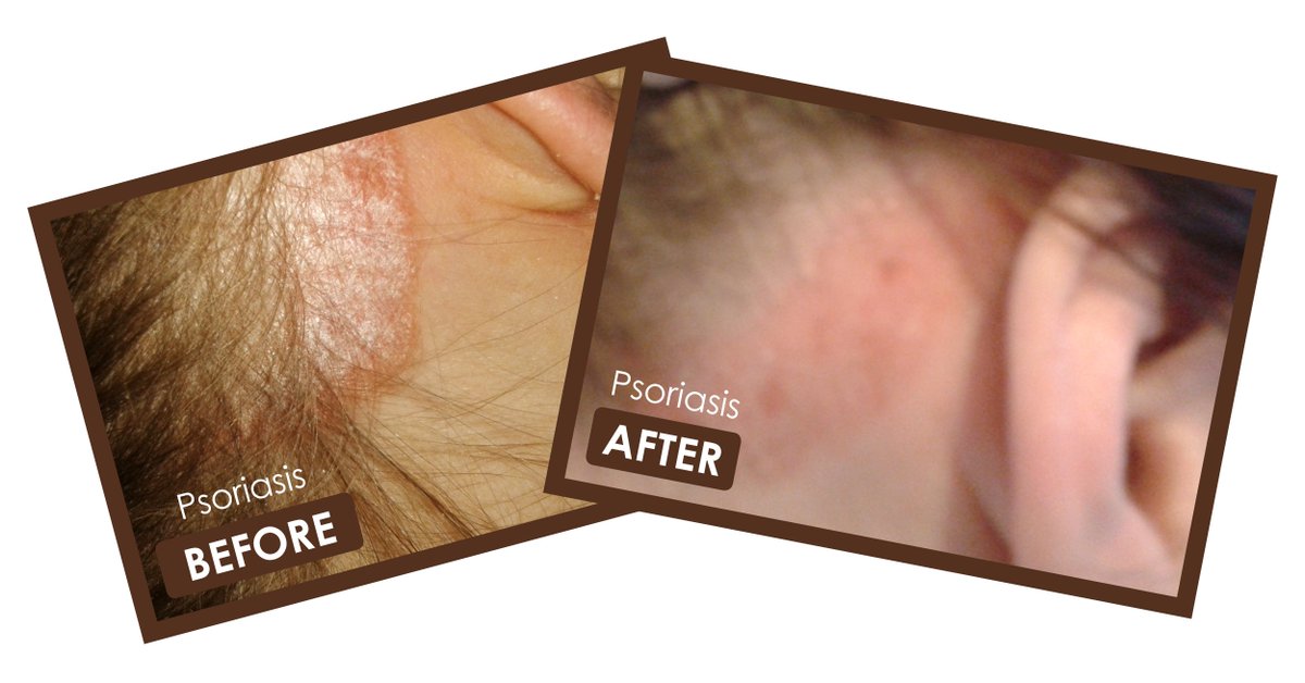 #ArganOil has been known reduce the appearance and effects of #psoriasis 
It can help to balance the skin cell production and bring it to a normal level so the scaly patches often reduce and in some cases disappear.