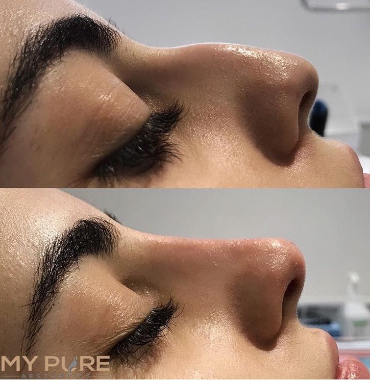 Mypurelondon's tweet photo. Dermal filler can be used to combat many facial areas that you might just want to tweak.

If you find areas leave you lacking confidence give us a call and let us help 02034 883020 or email info@mypureaesthetics.com

#dermalfiller #chindefinition #nosedefinition  #rhinoplasty https://t.co/Ztfp3bMusx