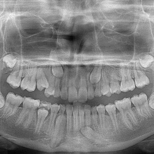 DrGorczyca's tweet photo. What is an Impacted Tooth?  https://t.co/afr5drTrYu #impactedtooth #impactedteeth #orthodontics #orthodontist #braces https://t.co/Z2BvMcHITE