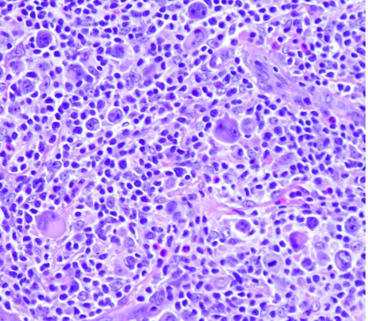 KMirza's tweet photo. @AustinMcHenry and I on the #SyncitialVariant of #ClassicHodgkinlymphoma #Lablogatory - #HotOffThePress @ASCP_Chicago @kellyswails @Blair_Holladay #hemepath @PathDocBoston @Sara_Jiang @AmeetRKini https://t.co/eHuGhvJZnr #PathElective https://t.co/4wd9r6tho1