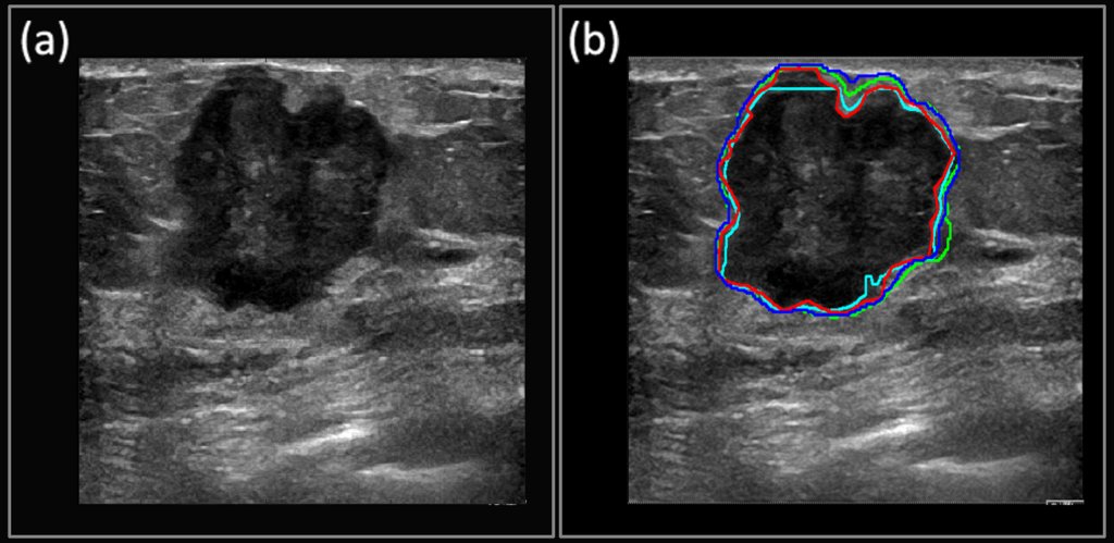 NVIDIAAI's tweet image. .@MayoClinic researchers use #deeplearning to classify ultrasound images for an affordable early detection solution in the fight against breast cancer. nvda.ws/2JuSX14
