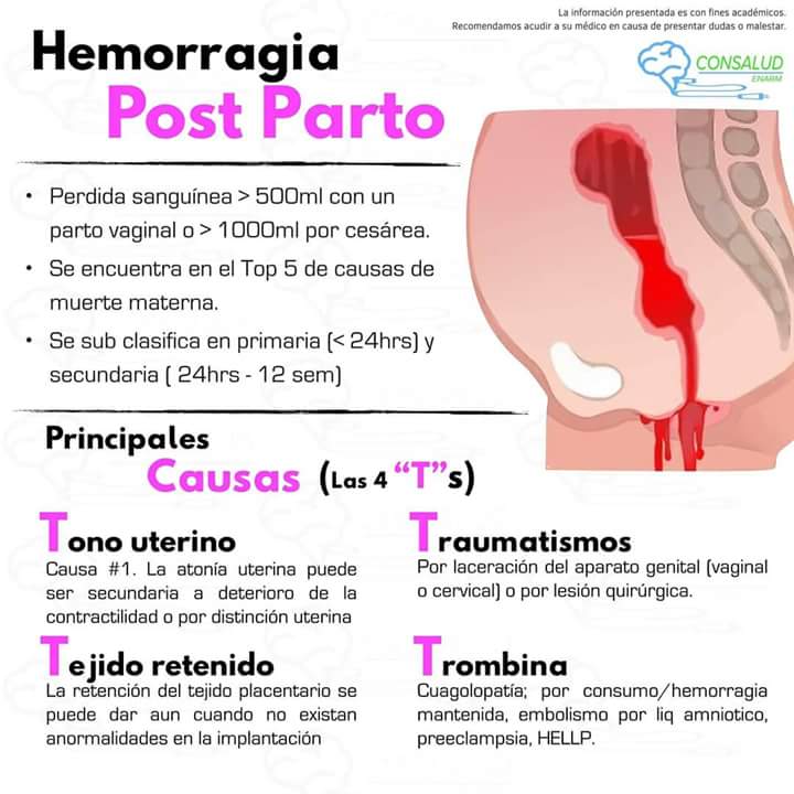 DoctourMundo's tweet photo. HEMORRAGIA POST PARTO: https://t.co/of5KAggVah