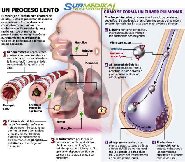 DoctourMundo's tweet photo. TUMOR PULMONAR: https://t.co/B1k6JUJflg