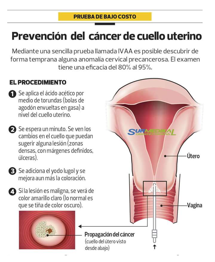 DoctourMundo's tweet photo. PREVENCION DEL CANCER DE CUELLO UTERINO: https://t.co/gAEB8w5cF1
