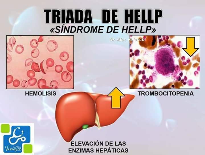 DoctourMundo's tweet photo. TRIADA DE HELLP: https://t.co/Lb4H4MTai4