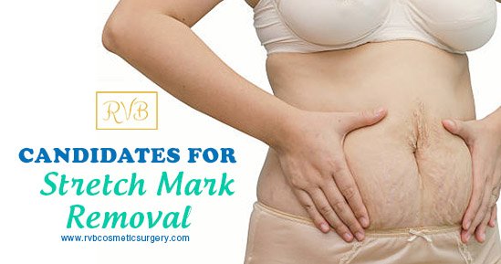 RVB_Cosmetics's tweet photo. People who have stretch marks because they lost a large amount of weight or women who had gone through childbirth and are sure that they won't be having any more children are good candidates for stretch mark removal. #stretchmark #cosmeticsurgery #flawlessskin #stretchmarkremoval https://t.co/KDCAsE1BSX