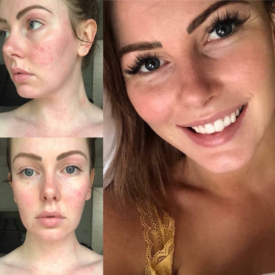 SKIN ✨ Jacelle! Our Aussie beauty is looking flawless 🙌
—————————————
“This was my skin at its worst. From eczema behind my eyes, down my neck and chest to blemishes and breakouts. It was horrible and I felt defeated. 10 months on 👇🏼

“I’ve never felt better in my own skin!”