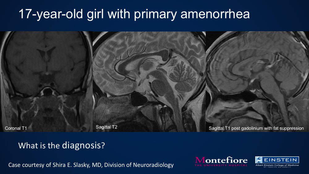 Montefiore Radiology (@montefiorerad) on Twitter photo Case of the Week, in honor of #ASNR18, from <a href="/ShiraSlaskyMD/">Shira Slasky</a> of the Division of #Neuroradiology. What is the diagnosis? <a href="/MontefioreNYC/">Montefiore Health System</a> #RadEd #FOAMed #FOAMRad #Radiology #CaseoftheWeek #COTW <a href="/AdGoldmanYassen/">Adam Goldman-Yassen, MD, MS</a> Case of the Week, in honor of #ASNR18, from <a href="/ShiraSlaskyMD/">Shira Slasky</a> of the Division of #Neuroradiology. What is the diagnosis? <a href="/MontefioreNYC/">Montefiore Health System</a> #RadEd #FOAMed #FOAMRad #Radiology #CaseoftheWeek #COTW <a href="/AdGoldmanYassen/">Adam Goldman-Yassen, MD, MS</a>