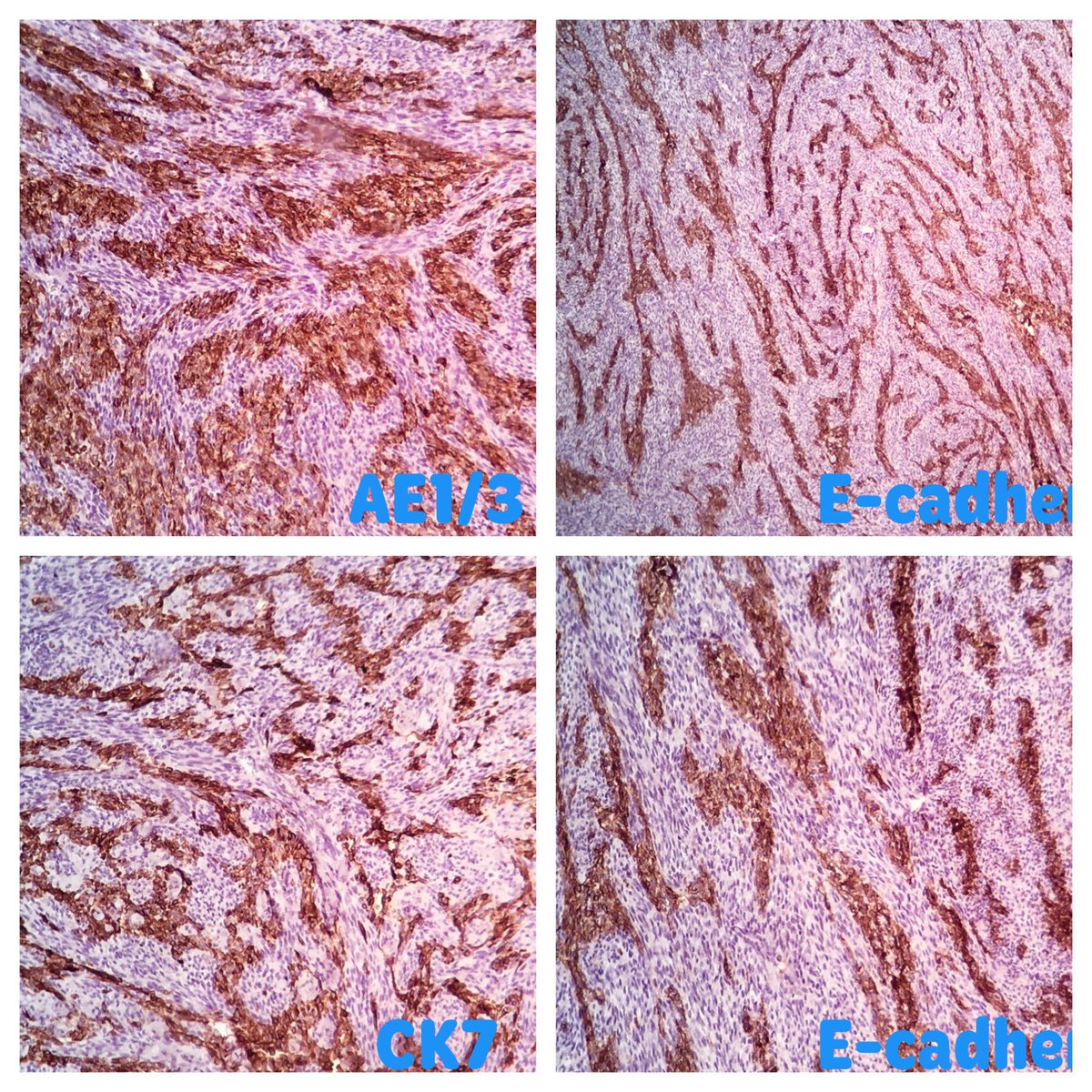 EIacovou's tweet photo. 39 yo man with a 9cm mass left forearm
#pathology, #softissuepath, #surgpath https://t.co/xtT6Vpdg3a
