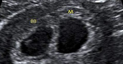 Twins: A Closer Look at Your Developing Babies bit.ly/2LtTI7R