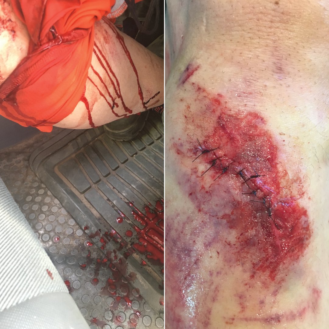 ProviderPrep's tweet photo. Our friend Randy crashed and landed on a sharp rock while mountain biking resulting in a deep laceration to his leg. Luckily we had the sufficient supplies in my #providerprepared kit to take care of it. We were saved a trip to the emergency room.

https://t.co/TP2DUexdaj https://t.co/lLFdn06SLr