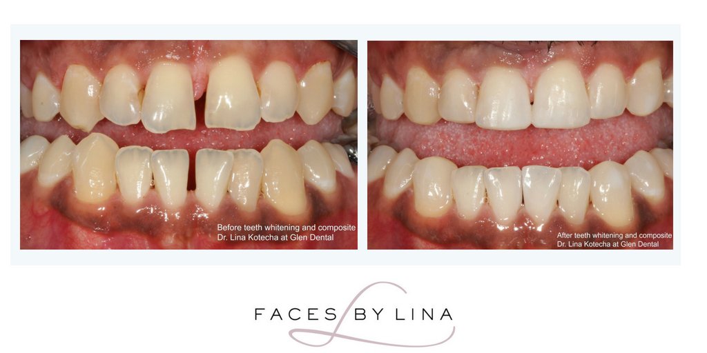 facesbylina's tweet photo. It’s a common misconception that Smile Makeovers always involve lengthy, costly &amp; extensive treatment. Here Dr Lina Kotecha has simply whitened the teeth &amp; carried out composite bonding. This happy patient now has a confident &amp; beautiful smile https://t.co/oQKC9zcflh #leicester https://t.co/KXfUHbsTlB