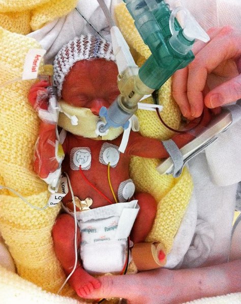 "This is Eva, at 6 days old, weighing 800 grams having her first blood transfusion. She really was not at all well at this point but 9mls of transfused blood helped make such an enormous difference. 9mls. It really isn’t much, but it's enough to save a premature baby's life."