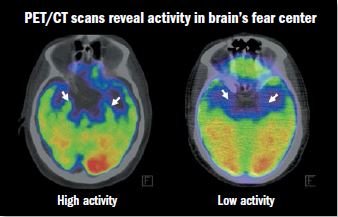 HarvardHealth's tweet photo. Uncovering the link between emotional stress and heart disease—your brain plays a bigger role than you think. https://t.co/wc7GnsRkmn #HarvardHealth #inflammation https://t.co/YLIVdGsoim
