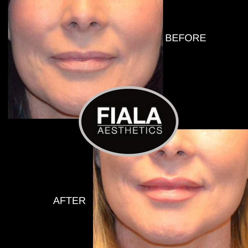 drfiala's tweet photo. Get the look you want now! Fiala Aesthetics medical spa offers a variety of cosmetic treatments in a medically-supervised, results-oriented setting. 
https://t.co/LKRLPGF0Jt
#BOTOX #Dysport #Filler #Injections #Juvederm #Restylane #Voluma #Sculptra 
#ThermiSmooth #SkinTreatments https://t.co/wCnCqxSOfY