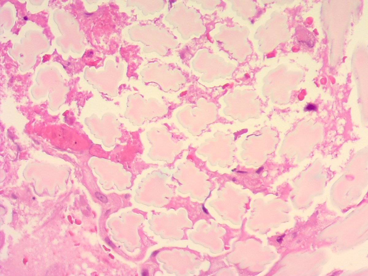 ariella8's tweet photo. Female on 60s .6 cm mass in rectus abdominalis .Can you identify this foreign material??#foreignbodies #PlasticSurgery #pathID #BSTPATH #gossypiboma https://t.co/QySfRtZeQc