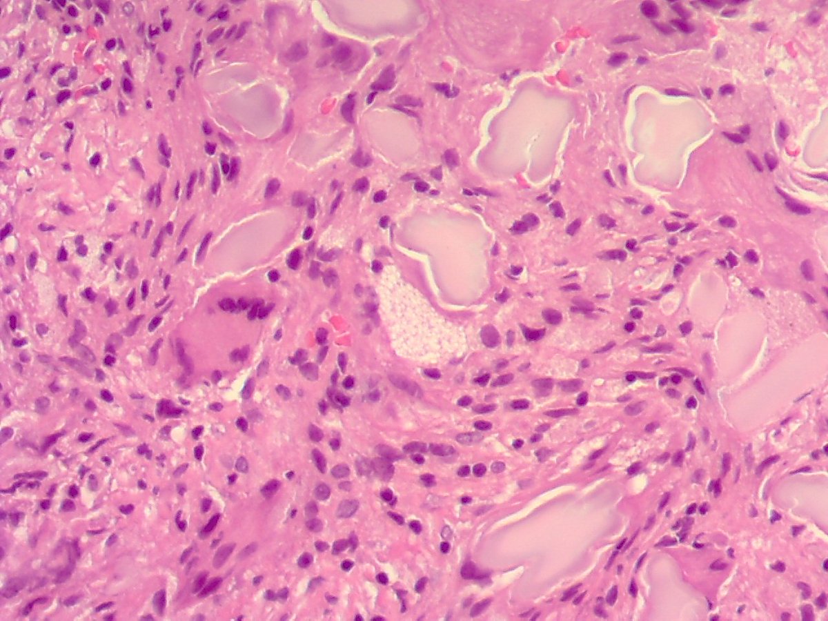 ariella8's tweet photo. Female on 60s .6 cm mass in rectus abdominalis .Can you identify this foreign material??#foreignbodies #PlasticSurgery #pathID #BSTPATH #gossypiboma https://t.co/QySfRtZeQc