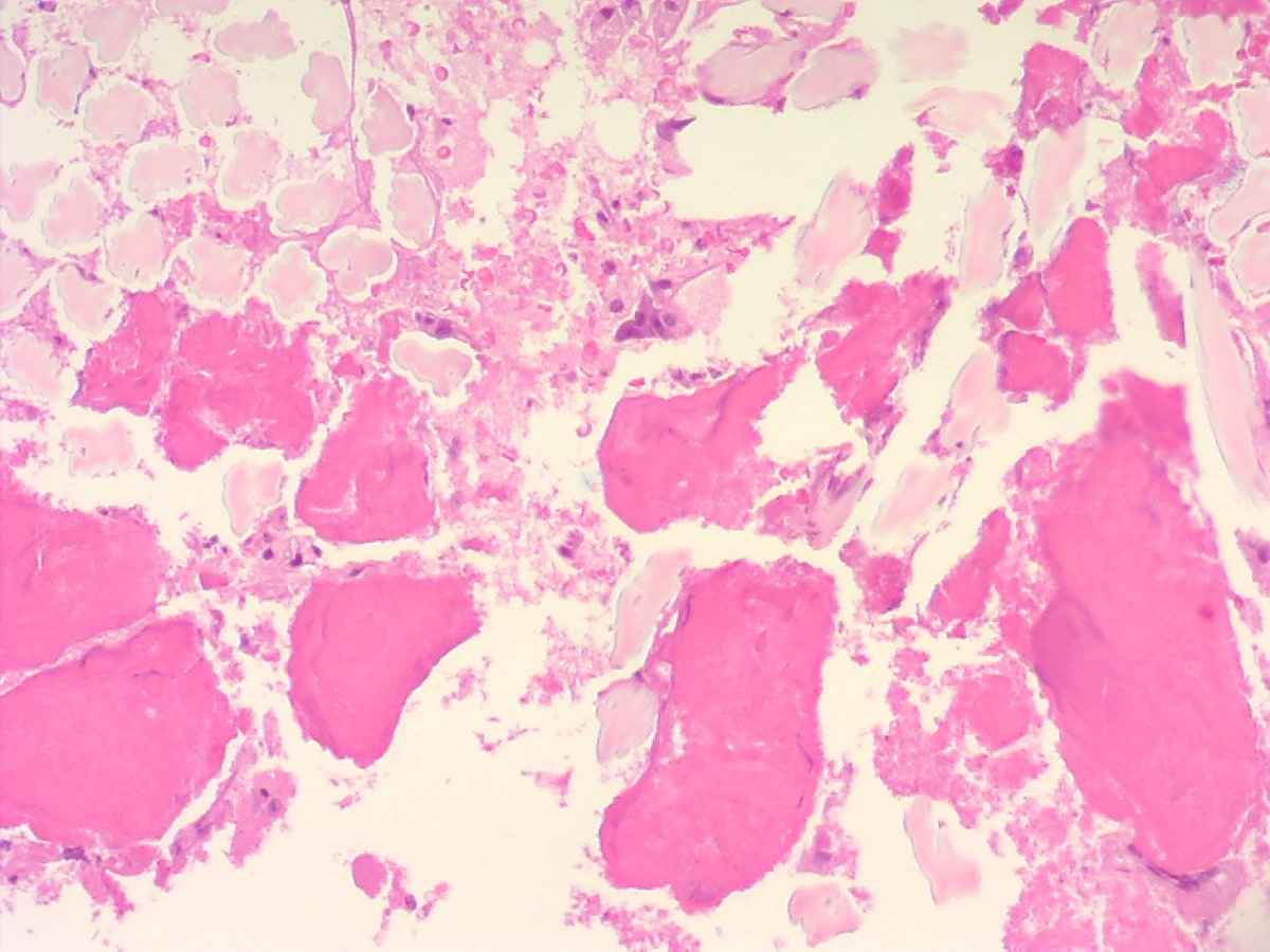 ariella8's tweet photo. Female on 60s .6 cm mass in rectus abdominalis .Can you identify this foreign material??#foreignbodies #PlasticSurgery #pathID #BSTPATH #gossypiboma https://t.co/QySfRtZeQc