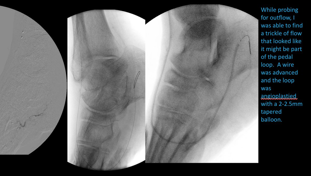 Watts_IR's tweet image. Outflow is essential in limb salvage! #MyLegMyLife #CLIFighters #2Tibs1Loop #OutpatientPAD #TwittIR
@CLI_Global @Mustapja @SIRRFS @SIR_ECS @FadiSaab17 @DrBTKatzen @pa_vascularinst @Drshiloh @drsavealimb